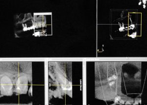 Dental-CT-Scan zeigt Kiefer- und Zahnstrukturen aus verschiedenen Blickwinkeln in Schwarz-Weiß-Darstellung.