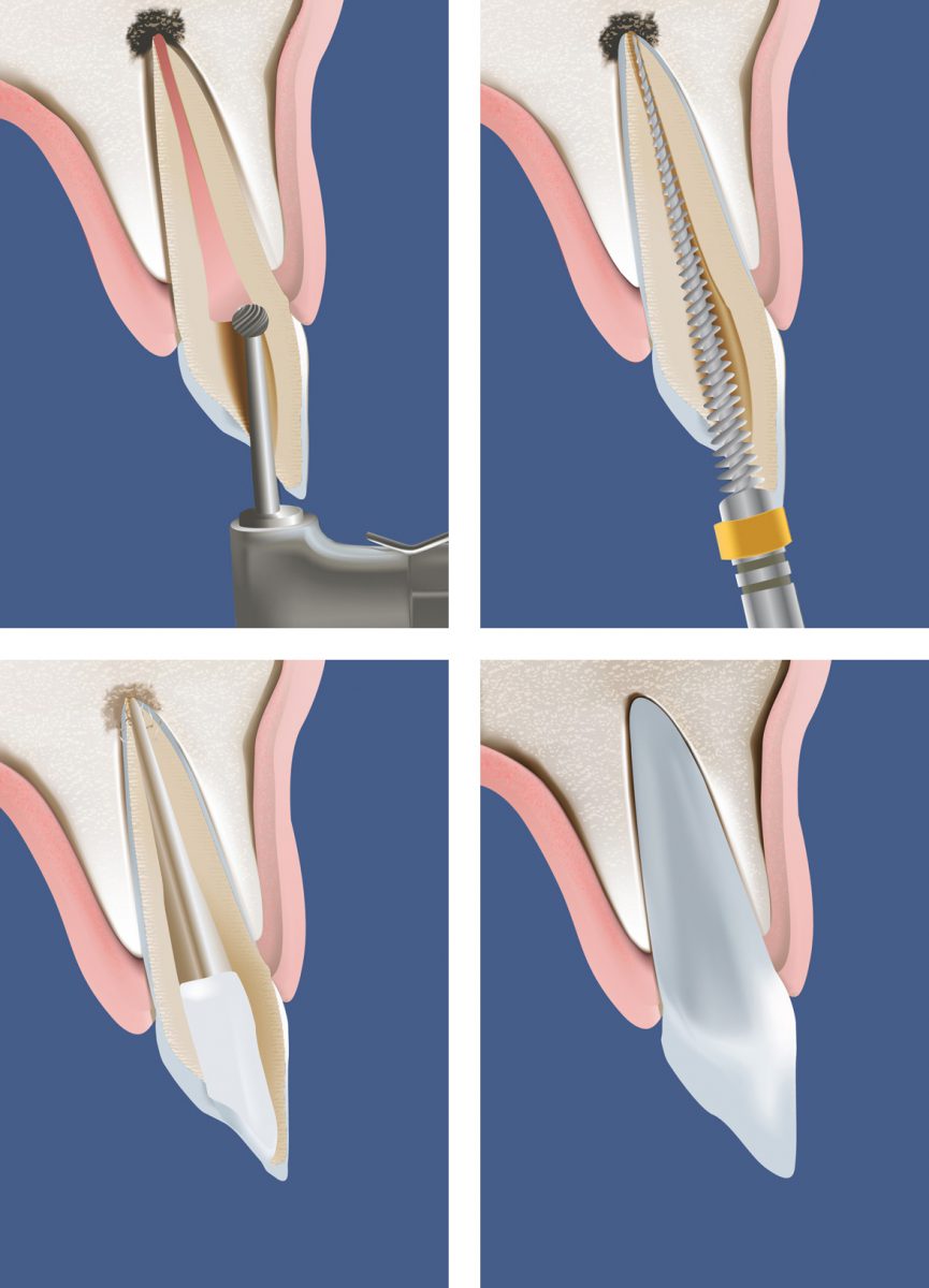 Endodontische Revision – Zentrum für Zahnmedizin in Berlin-Lichtenberg