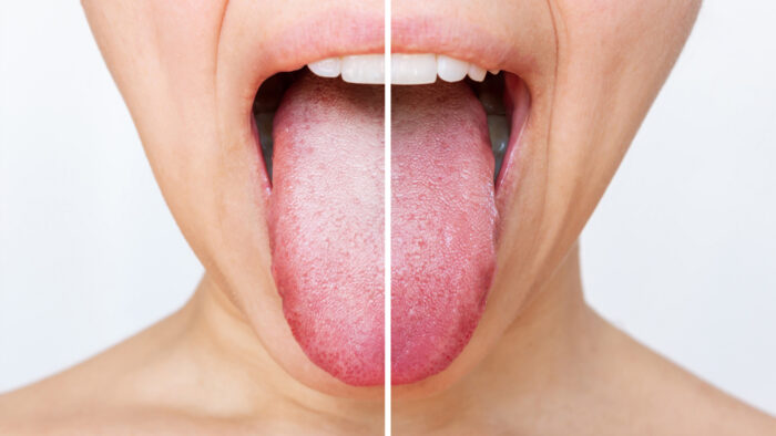 Zwei Zungendetails nebeneinander, links trocken, rechts feucht, menschlicher Mund in Nahaufnahme.