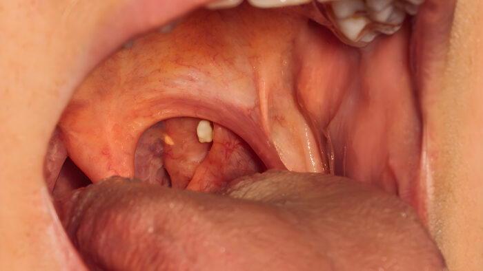 Nahaufnahme eines offenen Mundes, der eine Mandelentzündung mit sichtbarem Tonsillenstein zeigt.