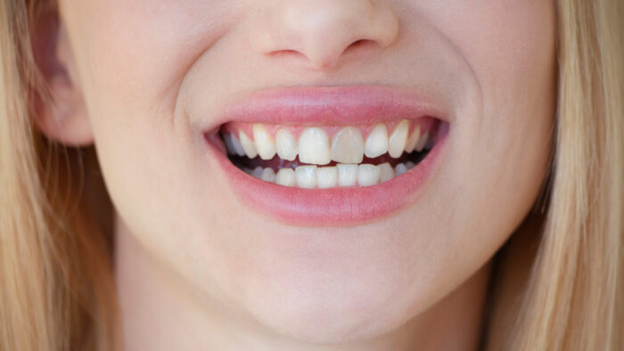 Nahaufnahme eines Lächelns mit sichtbaren Zähnen und blonden Haaren im Hintergrund.